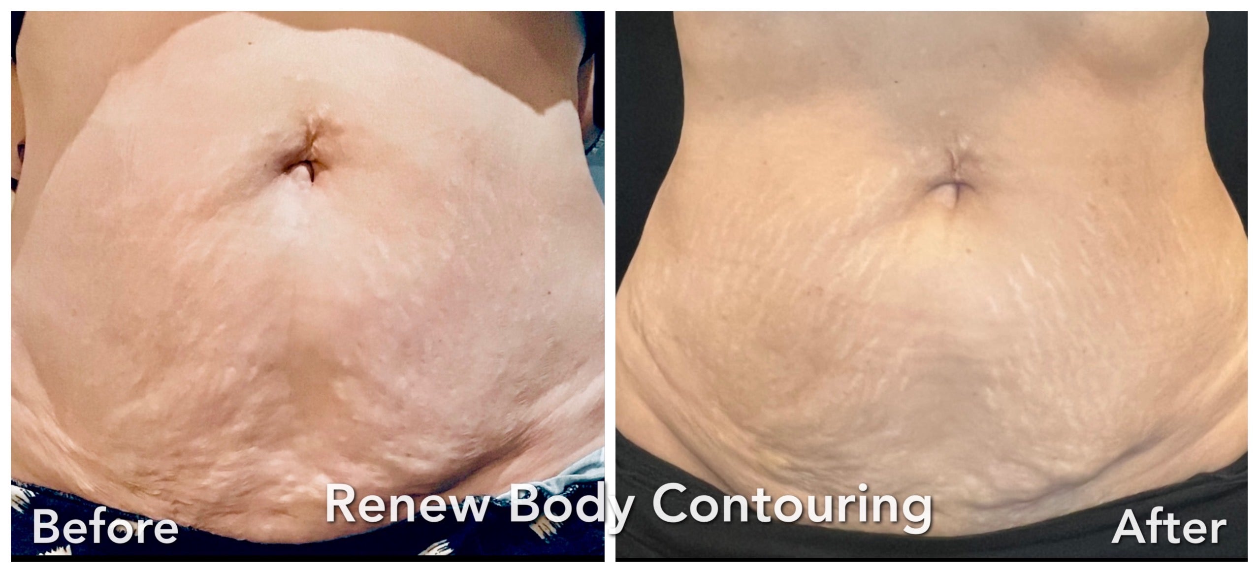 Stay Merry, Stay Light & Stay Tight w/ Our Customized Body Contouring Or Skin Tightening Packages!