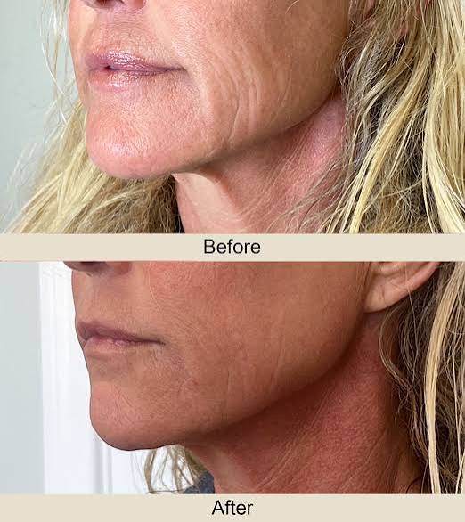 🎄 Morpheus8, Fractora, or PLEXR Plasma Face & Neck – 3 Treatments! ✨ Look Your Best This Year & Into 2026!