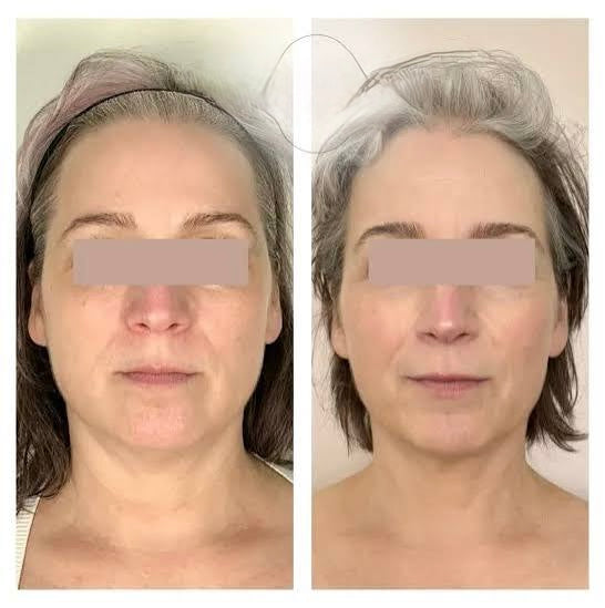 🎄 Morpheus8, Fractora, or PLEXR Plasma Face & Neck – 3 Treatments! ✨ Look Your Best This Year & Into 2026!