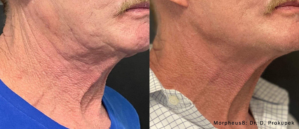 🎄 Morpheus8, Fractora, or PLEXR Plasma Face & Neck – 3 Treatments! ✨ Look Your Best This Year & Into 2026!