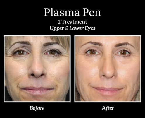 🎄 Morpheus8, Fractora, or PLEXR Plasma Face & Neck – 3 Treatments! ✨ Look Your Best This Year & Into 2026!