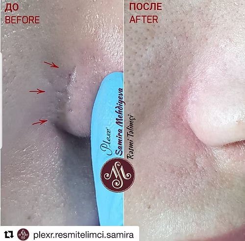 Love at First Lift – Plexr Beauty Treatment ♥️