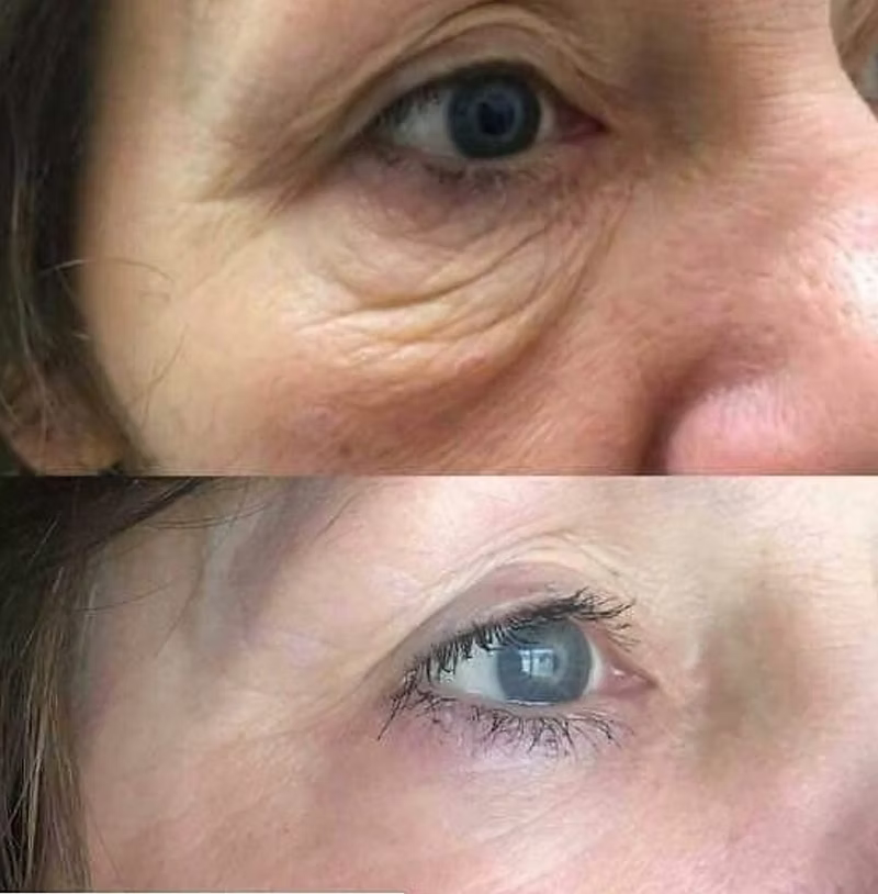 PLEXR Non-Surgical Eyelid Lift  Special!