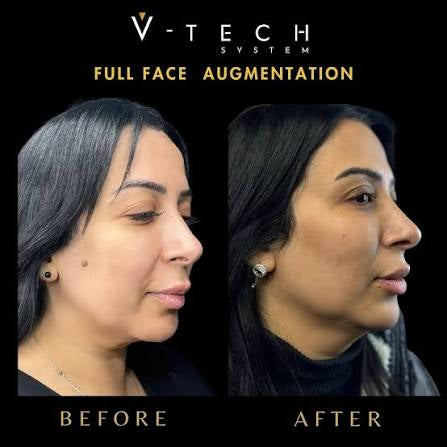 🎄✨ Glow & Go in 2026: 3 Microneedling Treatments with Skin Boosters for Face, Neck, or Chest! ✨🎄