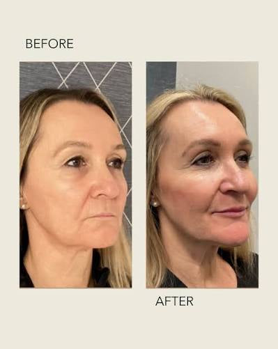 🎄 Morpheus8, Fractora, or PLEXR Plasma Face & Neck – 3 Treatments! ✨ Look Your Best This Year & Into 2026!