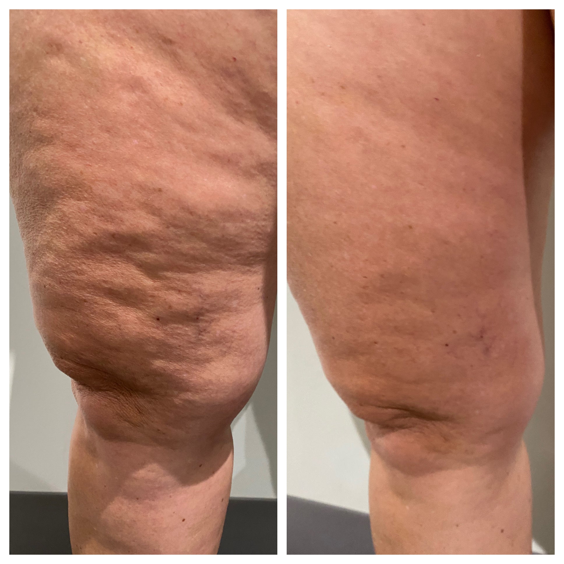 Get ready to sculpt and tighten your way to a fabulous summer with our exclusive special!