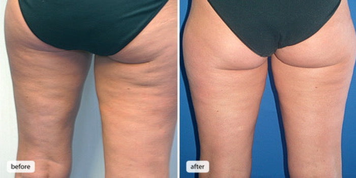 Stay Merry, Stay Light & Stay Tight w/ Our Customized Body Contouring Or Skin Tightening Packages!