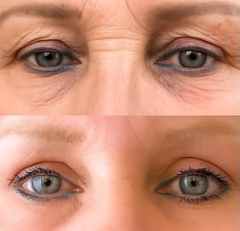 🎄 Morpheus8, Fractora, or PLEXR Plasma Face & Neck – 3 Treatments! ✨ Look Your Best This Year & Into 2026!