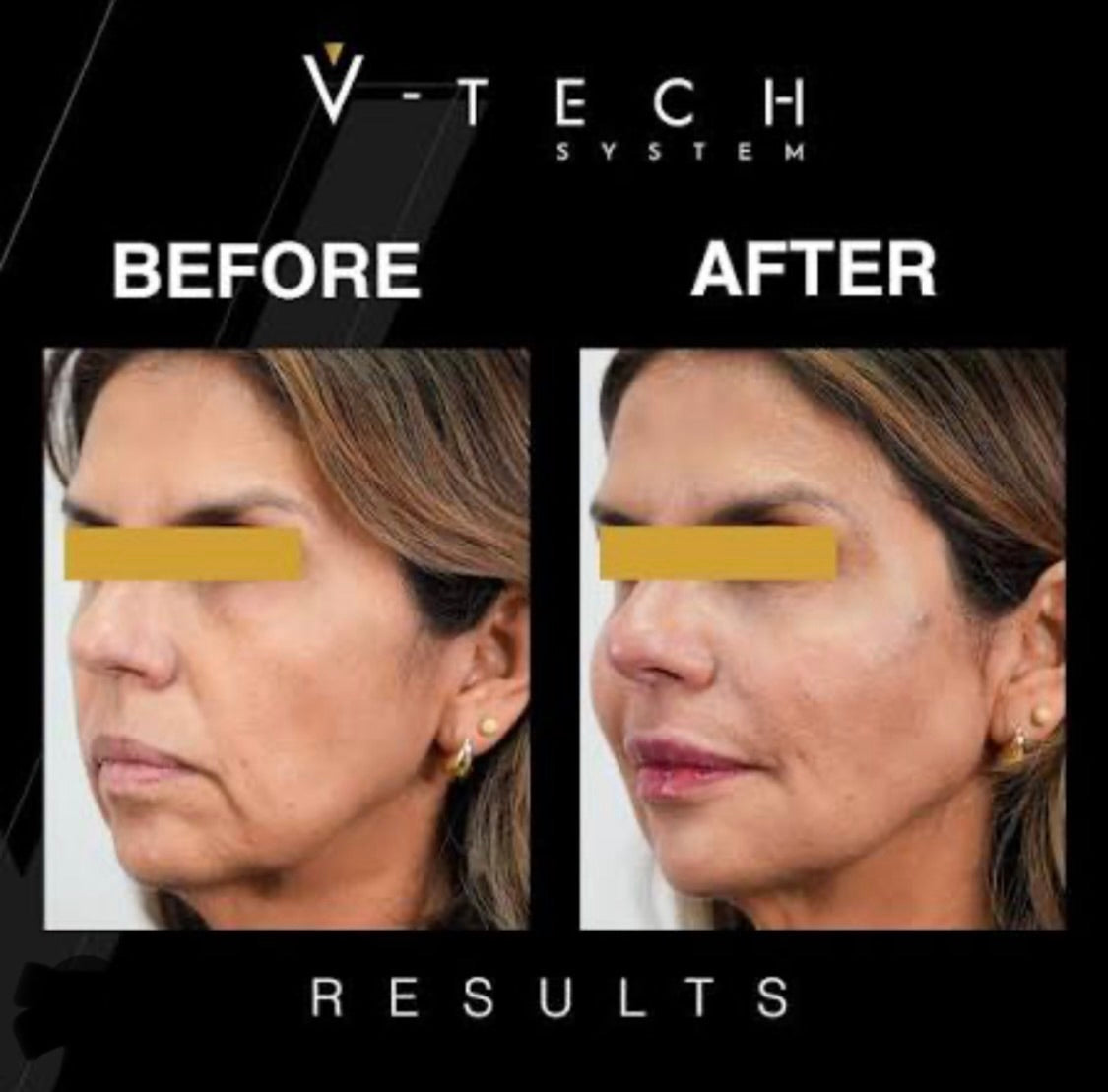 🎄✨ Glow & Go in 2026: 3 Microneedling Treatments with Skin Boosters for Face, Neck, or Chest! ✨🎄