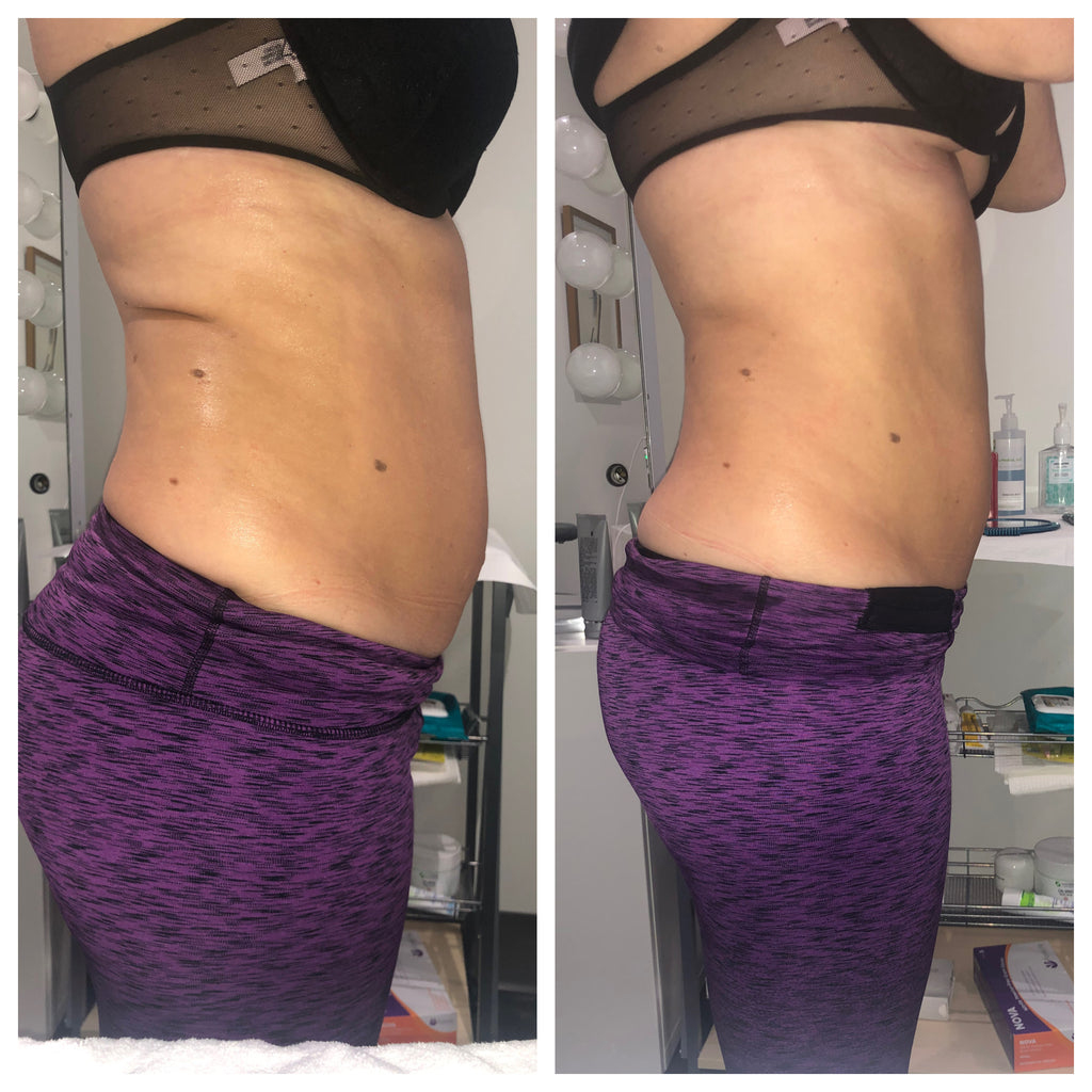 Stay Merry, Stay Light & Stay Tight w/ Our Customized Body Contouring Or Skin Tightening Packages!