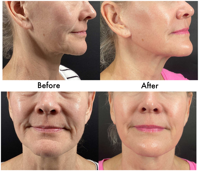 🎄 Morpheus8, Fractora, or PLEXR Plasma Face & Neck – 3 Treatments! ✨ Look Your Best This Year & Into 2026!