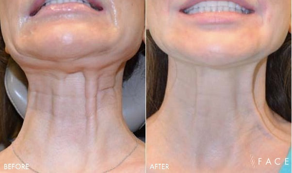 Nefertiti Neck Lift + Elite HydraFacial! No Wobble In Your Gobble For 2026