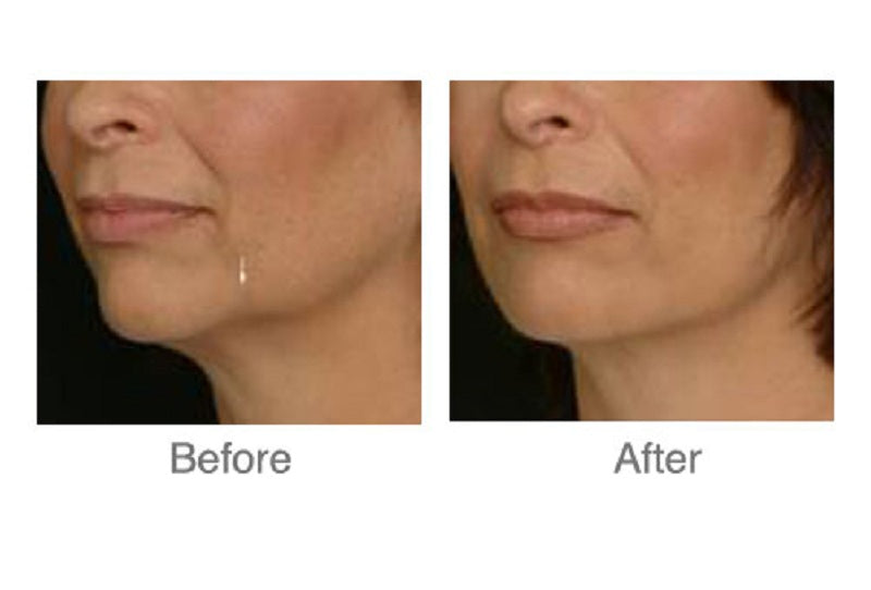 🎄 Full Vial TOX Wrinkle Relaxer + FREE HydraFacial – 12 Deals of Christmas ✨