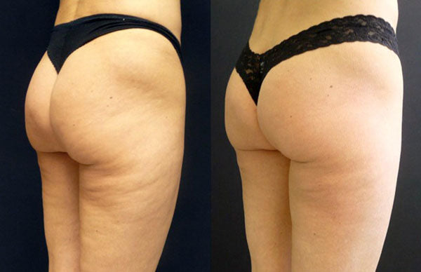 Get ready to sculpt and tighten your way to a fabulous summer with our exclusive special!
