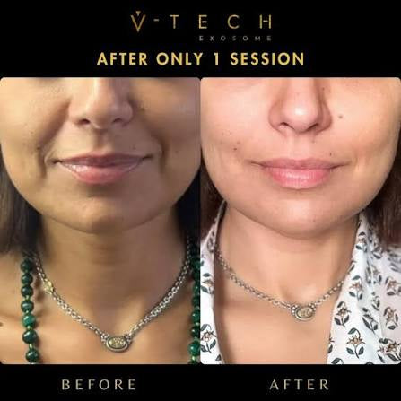 🎄✨ Glow & Go in 2026: 3 Microneedling Treatments with Skin Boosters for Face, Neck, or Chest! ✨🎄