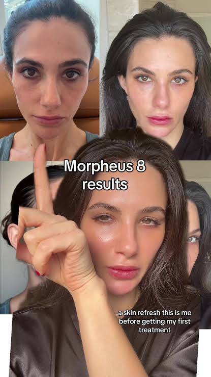 🎄 Morpheus8, Fractora, or PLEXR Plasma Face & Neck – 3 Treatments! ✨ Look Your Best This Year & Into 2026!