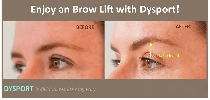 Purchase 100 Units Of Dysport Get 25 Units Free + A FREE HydraFacial + $100 Gift Card