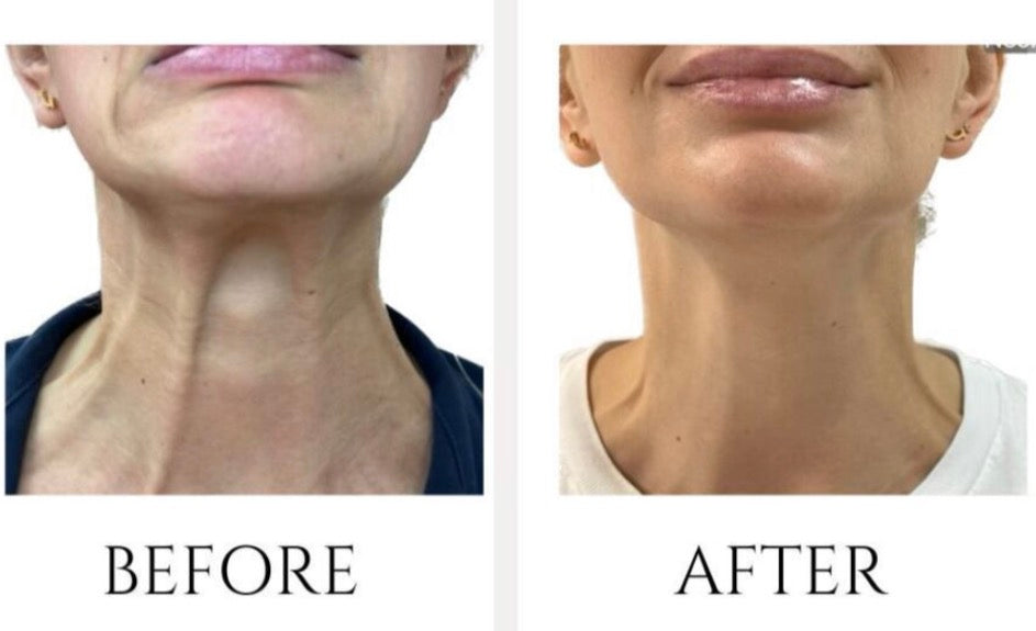 🎄 Full Vial TOX Wrinkle Relaxer + FREE HydraFacial – 12 Deals of Christmas ✨