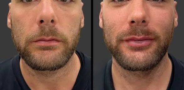 Love At First Pout ♥️