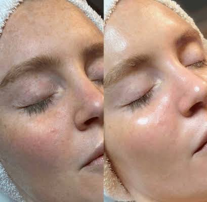 🎄 12 Deals of Christmas: Glow Into 2026! ✨3 Elite HydroFacials for Your Brightest 2026!