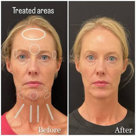 Purchase 100 Units Of Dysport Get 25 Units Free + A FREE HydraFacial + $100 Gift Card