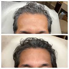 Renew Follicle ADVANCED Activation System (Front through Crown)