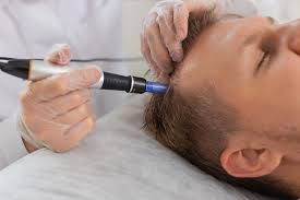 Renew Follicle ADVANCED Activation System (Front through Crown)